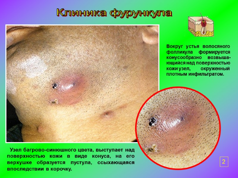 Вокруг   устья   волосяного фолликула     формируется конусообразно